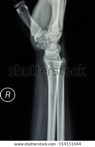Wrist, forearm x-rays, side