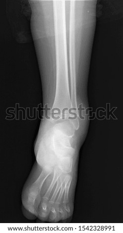 normal radiography of the ankle joint in direct projection, traumatology and orthopedics rheumatology