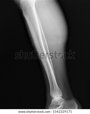 normal radiography of the ankle joint in lateral projection, traumatology and orthopedics rheumatology