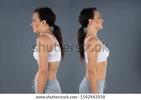Woman With Kyphosis And Normal Curvature Against Gray Background Royalty-Free Stock Photo #1542442058