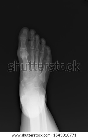 normal radiography of the foot, medical diagnostics, traumatology and orthopedics