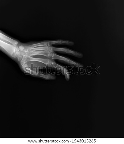 normal x-ray of the hand bones and fingers,orthopedics, medical diagnostics, rheumatology