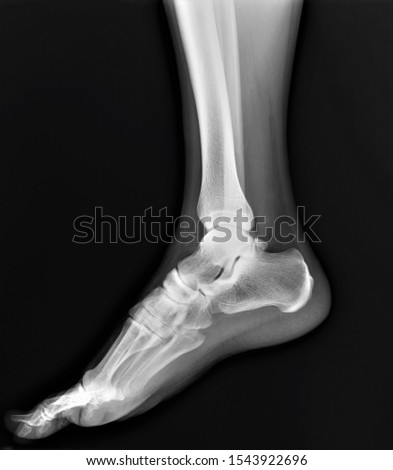 normal radiography of the ankle joint in lateral projection, traumatology and orthopedics rheumatology