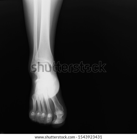 normal radiography of the ankle joint in direct projection, traumatology and orthopedics rheumatology