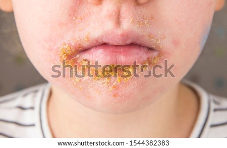5 year old child with Impetigo (nonbullous impetigo) witch is is a bacterial infection that involves the superficial skin. Yellow scabs on infected area. Royalty-Free Stock Photo #1544382383