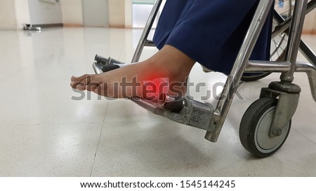 Diabetic wound and gauze bandage. Diabetic foot is complication from diabetes mellitus (DM) disease. The patient has infection, ulcer and neuropathic osteoarthropathy syndrome. Medical care concept Royalty-Free Stock Photo #1545144245
