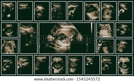 Ultrasound pictures composition. Pregnancy concept, 4th month fetus.