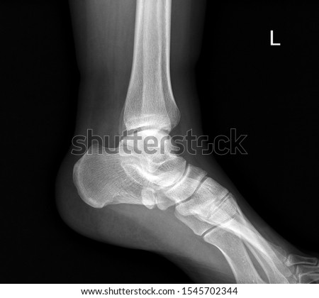 close-up x-ray image of the foot.