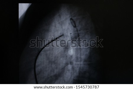 X ray image perform PDA device closure after treatment patent ductus arteriosus disease (PDA)
