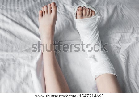 Broken leg in white plaster lies on the bed. A broken leg in white plaster lies on the bed. Health and medicine concept