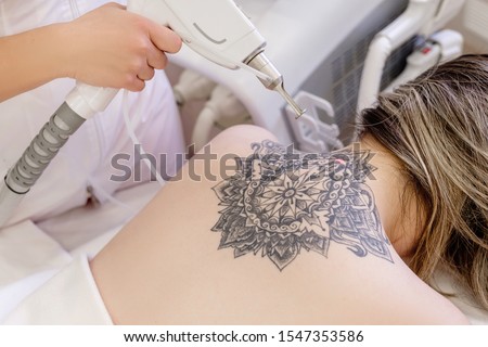 Top view hand of a beautician holds a laser device over a tattooed back of a girl to remove an unwanted tattoo. Concept of erasing tattoos as an expensive procedure in beauty parlor Royalty-Free Stock Photo #1547353586