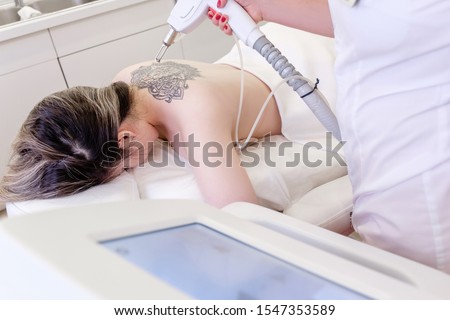 Top view hand of a beautician holds a laser device over a tattooed back of a girl to remove an unwanted tattoo. Concept of erasing tattoos as an expensive procedure in beauty parlor Royalty-Free Stock Photo #1547353589