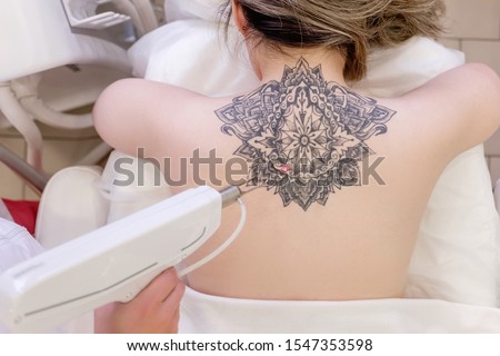 Top view hand of a beautician holds a laser device over a tattooed back of a girl to remove an unwanted tattoo. Concept of erasing tattoos as an expensive procedure in beauty parlor Royalty-Free Stock Photo #1547353598