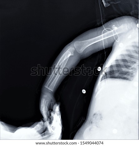 x-ray of the normal elbow joint