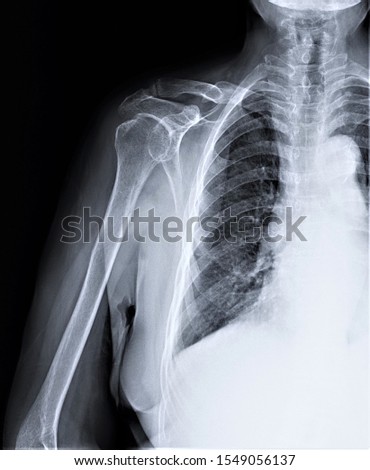 normal radiography of the shoulder joint and ribs in direct projection, Traumatology and orthopedics, traumatology
