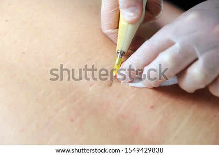 Carbon dioxide therapy (carboxytherapy). Skin rejuvenation.The procedure is performed on the back of the patient.

 Royalty-Free Stock Photo #1549429838