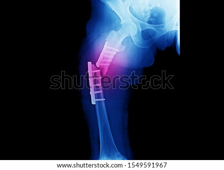 Hip and thigh x-ray showing closed fracture at shaft of right femur. The patient has underwent fixation with plate and screws. The image shows implant failure or broken plate at the fracture site. Royalty-Free Stock Photo #1549591967