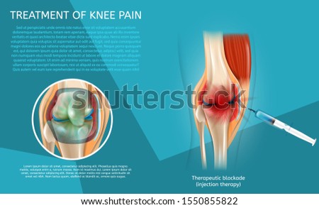 Realistic Illustration Treatment of Knee Pain. 3d Image Banner Therapeutic Blockade Human Knee Joint. Syringe Injection. Medical Poster Procedure and Result Treatment with Injection Therapy.