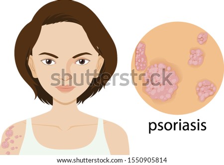 Woman with psoriasis on poster illustration