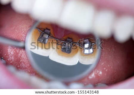 invisible lingual braces on dental mirror Royalty-Free Stock Photo #155143148