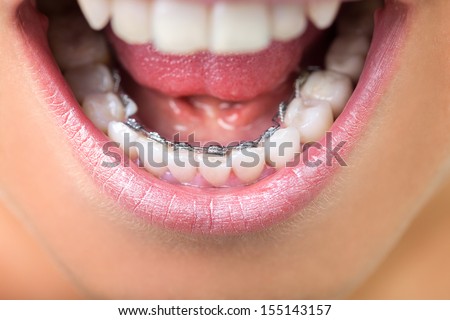 Young woman showing lingual braces, close up  Royalty-Free Stock Photo #155143157