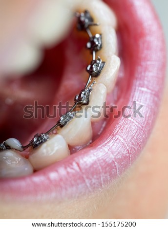 Young woman with lingual braces Royalty-Free Stock Photo #155175200