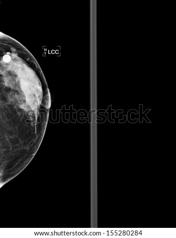 mammography  breast scan X-ray picture