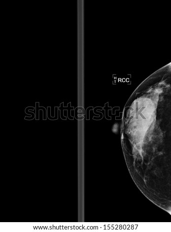 mammography  breast scan X-ray picture