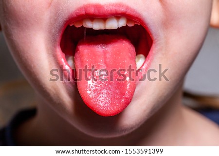 Tongue of a child with scarlet fever - strawberry tongue. Royalty-Free Stock Photo #1553591399
