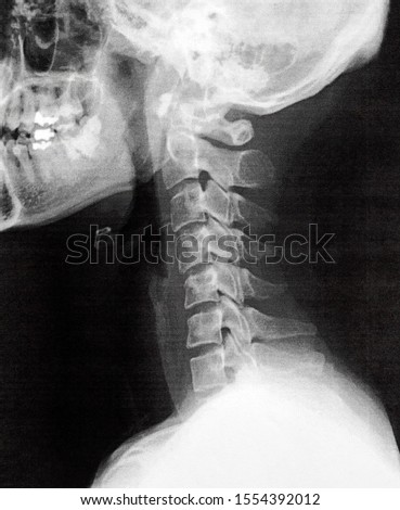  Military neck seen in X-ray