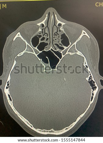 Close fracture at lateral wall of right sphenoid sinus with hemosinus , subtle brain edema of right medial temporal lobe