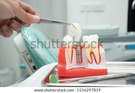 Examples of dental implants that shows when in the jawbone of the patient compare with the neighboring natural teeth. To educate patients in the treatment of dental implants. Royalty-Free Stock Photo #1556297819
