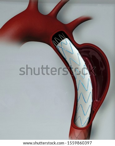 model of thoracic endovascular aortic repair (tevar) for people education Royalty-Free Stock Photo #1559860397