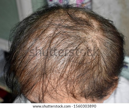 Thinning or sparse hair, male pattern hair loss in Southeast Asian, Chinese elder man. Royalty-Free Stock Photo #1560303890