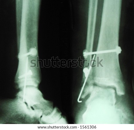 x-ray picture of human leg after operation