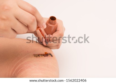 Surgical wound, skin suture after surgery