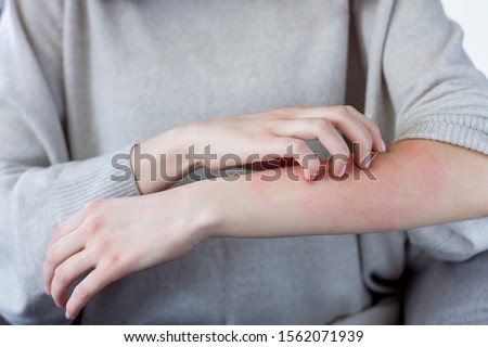 Closeup girl is scratching her hand with nails. Reddened, inflamed body parts causes discomfort and itching. Young woman is suffering from bouts of allergies. Dermatological skin diseases concept. Royalty-Free Stock Photo #1562071939