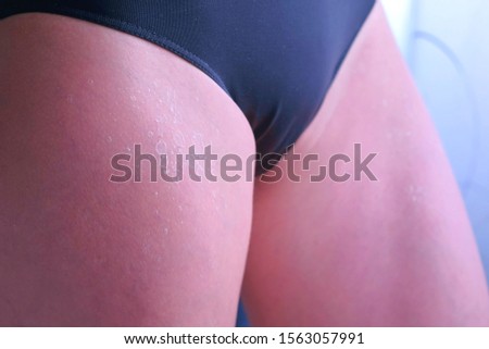 Woman in panties with peeling skin from UV sunburn on legs, closeup view. UV exposure causes sun burns and skin irritations. Burnt skin after exposing too much to the sun.