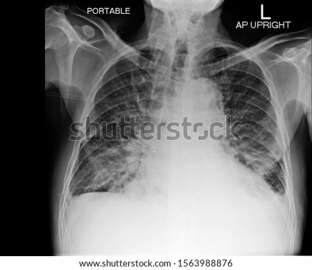 film X-ray of human thorax show cardiomegaly and pulmonary oedema suggest heart failure Royalty-Free Stock Photo #1563988876