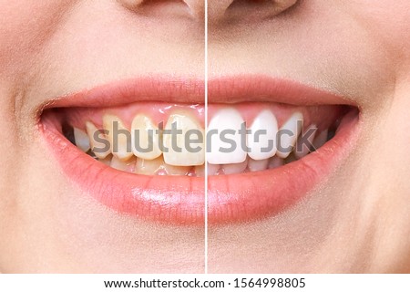 woman teeth before and after whitening. Over white background. Dental clinic patient. Image symbolizes oral care dentistry, stomatology. Royalty-Free Stock Photo #1564998805