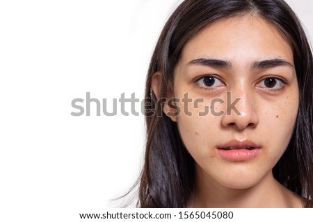 Asian woman gets freckles, blemish, pimple and dull skin on her face. Attractive beautiful Asia woman get eye dark circles, She get no makeup on face. She look unhappy. isolated on white, copy space
