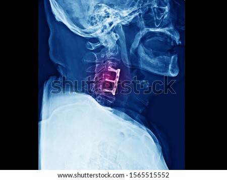 Lateral projection cervical spine x-ray showing anterior cervical discectomy and fusion or ACDF procedure. The patient has spinal cord compression and myelopathy due cervical spondylosis. Royalty-Free Stock Photo #1565515552