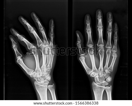 ULNAR-GUTTER Stock Photos and Images - Avopix.com