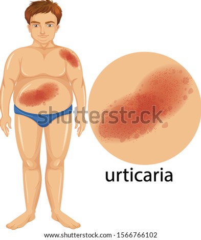 Diagram showing man with urticaria illustration