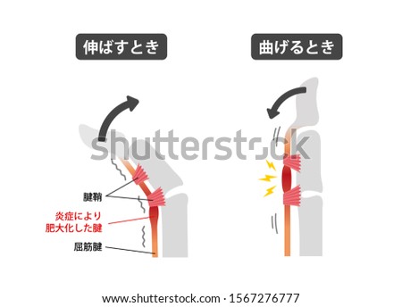 Trigger finger causes and symptoms illustration / Japanese. translation: when stretching,Tendon sheath,Inflamed tendon,Tendon,when bending