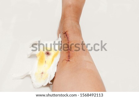 Scar after leg surgery from fracture