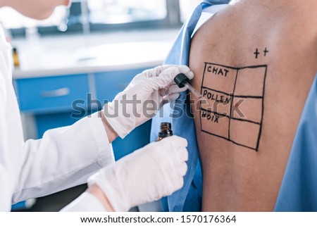 cropped view of allergist in latex gloves holding pipette and glass bottle near man with marked back 