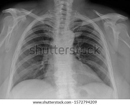 normal radiography of the shoulder joint and ribs in direct projection, Traumatology and orthopedics,pulmonology