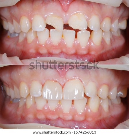 distema closure with direct composite filling Royalty-Free Stock Photo #1574256013