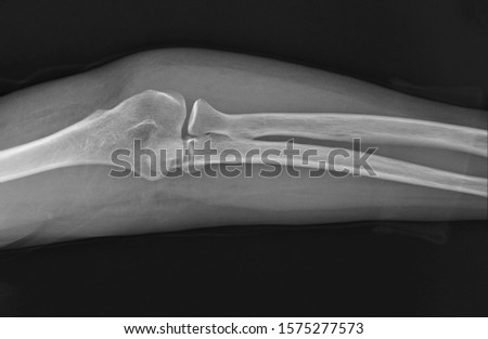 x-ray of the normal elbow joint. traumatology and orthopedics, medical diagnostics, rheumatology